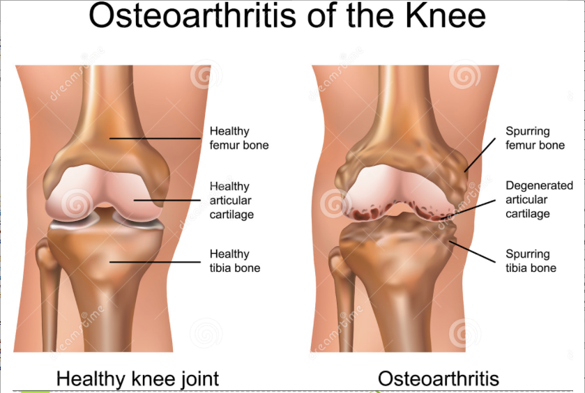 Perbandingan sendi normal dengan sendi yang mengalami Osteoarthritis (sumber www.smwhome.net)